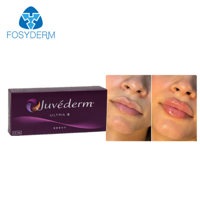 Juvederm Dermale Lip Fillers 2*1 ml Hyaluronzuur Cross Linked Injection