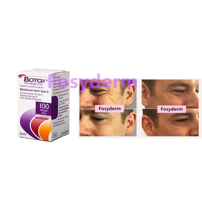 100 eenheden Botulinum Toxin Allergan Anti Wrinkles Injectie Botox Type A