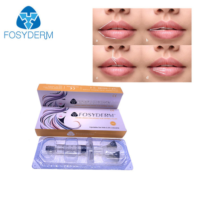 Hyaluronzuur injecteerbare huidvuller 1 ml 2 ml voor lippenvergroting