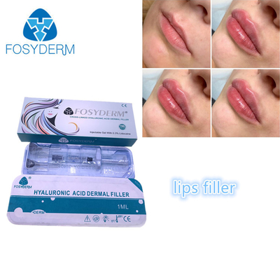 Het vullen van de Lippenvullers 1ml van Fosyderm Fosyderm van de Gezichtsinjectie Hyaluronic Zure