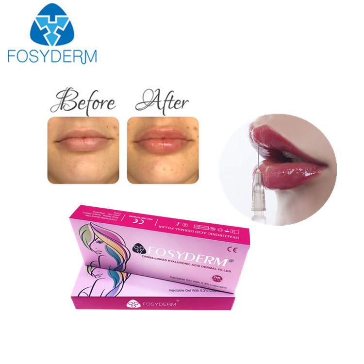 1ml hyaluronic zure Injectie van de de Lippenverhoging van Derm van lippenvullers voor Vrouwen