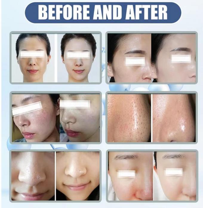 Beste gezichtsverzorging thuis Microdermabrasie machine 2024 schoonheidsapparatuur 6