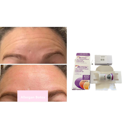 Botulinum de Toxinetype A van Allergans 100iu voor Antirimpels