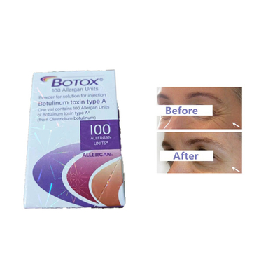 De Injectie Botulinum Toxine van Allerganbotox 100 Rimpels van het Eenhedenvoorhoofd