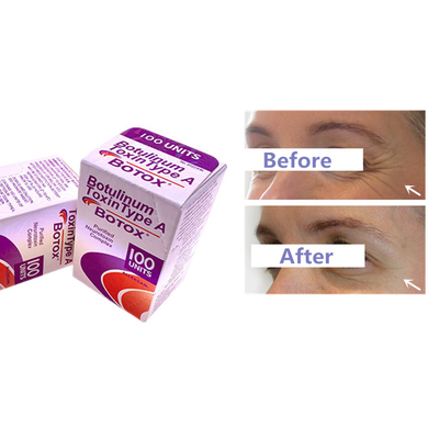 Botulinum Injectie van Toxineallergan  voor Rimpel verwijdert