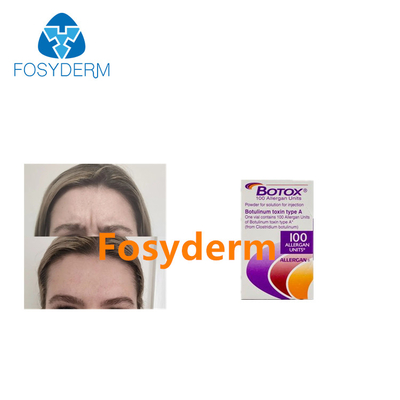 Injecties van de Allergan verwijderen Botulinum Toxine Rimpels 100 Eenheden van