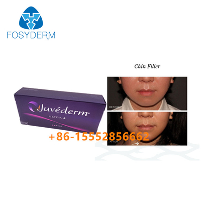 Chin Augmentation Hyaluronic Acid Facial-Vuller Juvederm Ultra4 Huid2ml