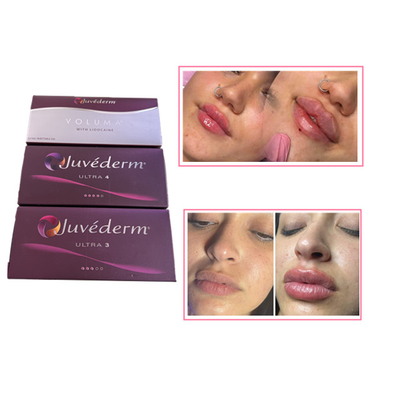 Huidverzorging Injecties Lipp Plumper Juvederm Hyaluronzuur Dermale vulmiddel voor het gezicht