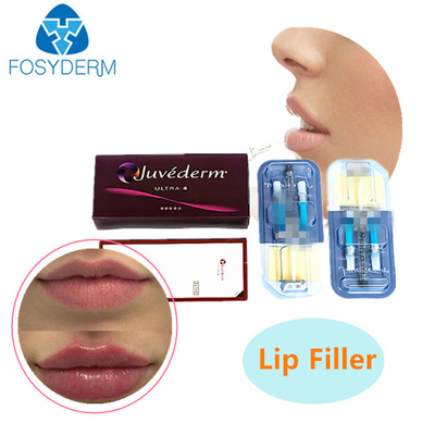 2 ml huidvuller met hyaluronzuur JUVEDERM Injecteerbare gelrimpvuller