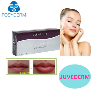 Juvederm Hyaluronic Acid Dermal Filler Sexy Lippen 24mg Voor Gezicht Filler