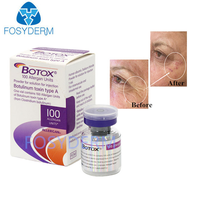 100 Eenheden Botulinum Anti Wrinkle Toxin Allergan Injectie  Voor Anti-Aging Behandeling