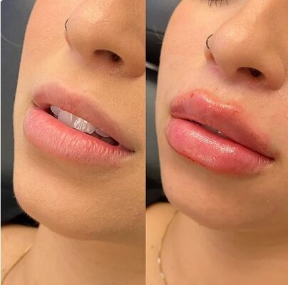 Red Lip Filler With Vitamin B12 Hyaluronic Acid Filler Gel For Lips