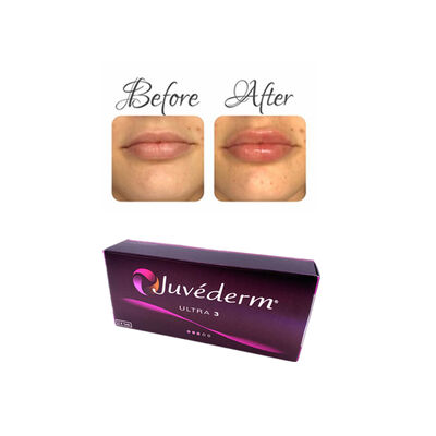 Juvederm Hyaluronic acid dermal filler Ultra4 24mg