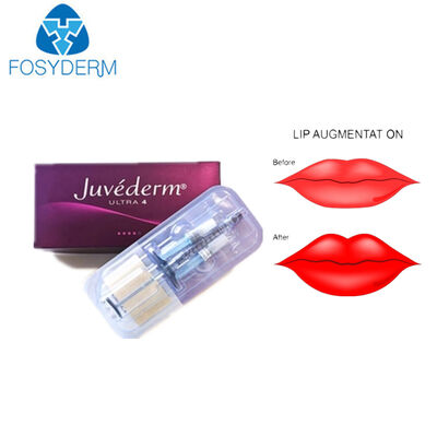 Juvederm Hyaluronic acid dermal filler Ultra3 Lips Lifting
