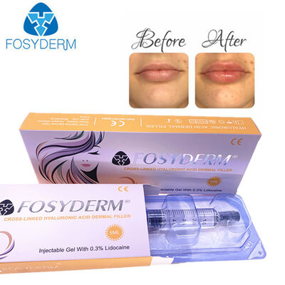 Hyaluronzuur Huidvuller Anti Rimpels Gezichtslift 1ml 2ml