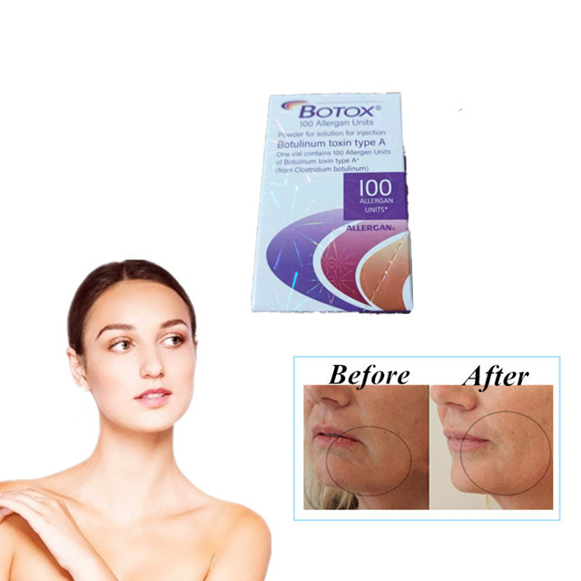 Allergan  100 eenheden Soorten Botulinetoxine-injectie Anti-rimpels