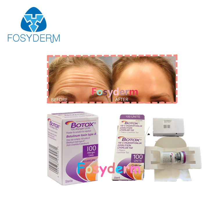 100Units Botulinum Antiinjectie TypeA  van Allergan van de Rimpeltoxine