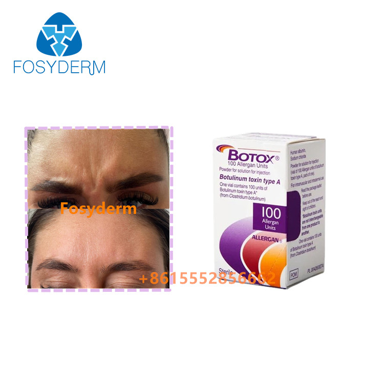 Verwijder rimpels Injectie Allergan Botulinum Toxin  Type A 100eenheden