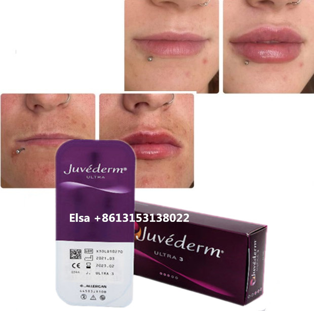 Cosmetica Huidverzorging Injecties Lip Plumper Juvederm Filler Injectie Voor Neus Chin Lip