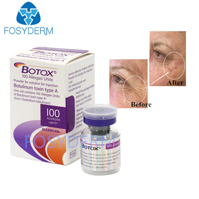 Type A 100 Eenheden Allergan Botulinum Toxin Dermale vulmiddel Hyaluronzuur