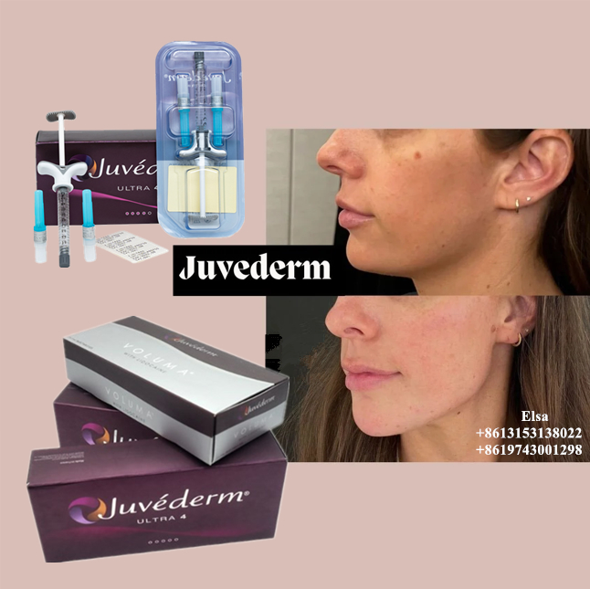 Juvederm ultra3 Juvederm ultra4 Juvederm voluma Dermal filler