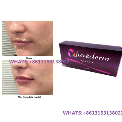 Juvederm huidvuller voor lippen Juvederm Ultra3 Ultra4 vullers voorgevulde spuit
