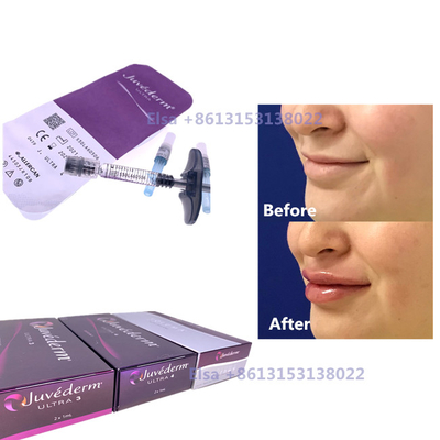 2×1 ml injecteerbare huidvuller Juvederm-spuit Ultra3 Ultra4 Voluma