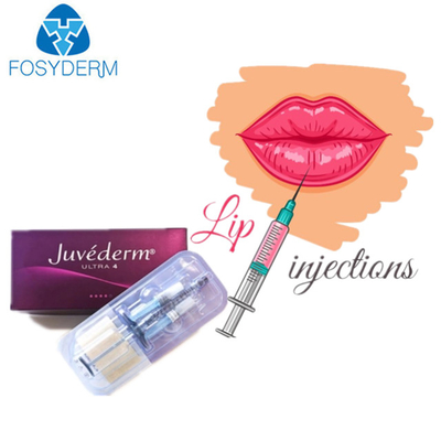 Juvederm Hyaluronic Zure Huidvuller ultra 3 voor Gezichtslippen
