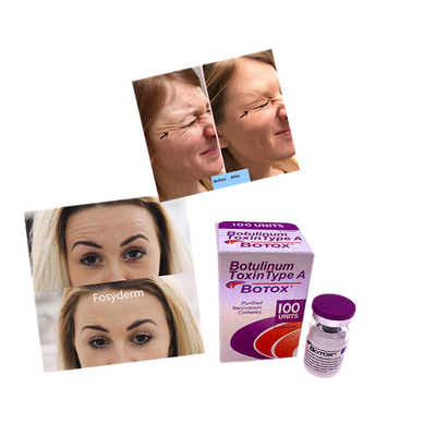 Huidvuller Antirimpel Allergan  100 van Botulinum Poedereenheden Injectie