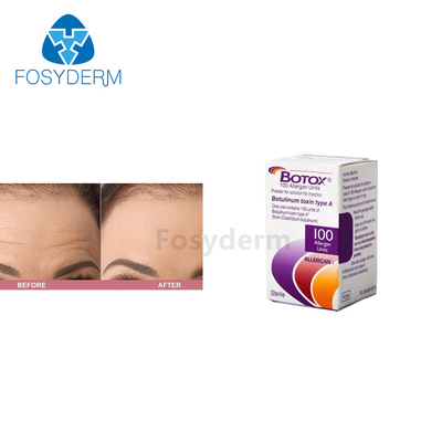 100 van Botulinum de Toxineeenheden Injectie van Allergan  voor Antirimpels