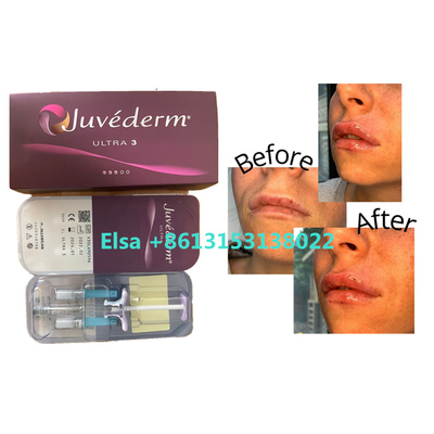 De Huidvuller van cosmetischee productenjuvederm voor Gezichtslippen