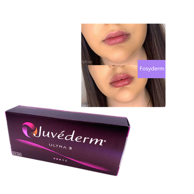 2 ml Juvederm Hyaluronzuur Huid Filler Rimpel Filler Kin Lippen Ultra 3
