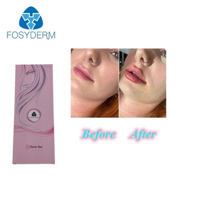 1ml 0,3% Lidocaine Hyaluronic Zure Injectie van de Lippenvuller