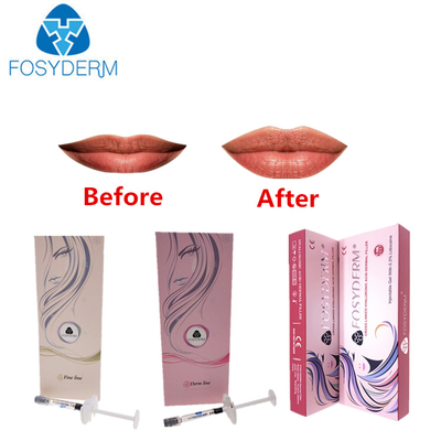 Rimpels en Lippen Hyaluronic Zure Injecteerbare Vuller met Lidocaine