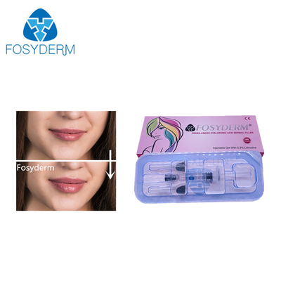 2 ml vulmiddel Hyaluronzuur Dermale vulmiddel voor gezicht Neus Lipvergroting 24 mg/ml
