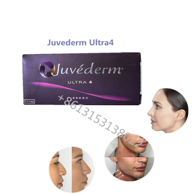 Vullers van de Vullerjuvederm Ha van Juvederm Ultra4 Allergan van de lippenvolheid de Huid voor Lippen