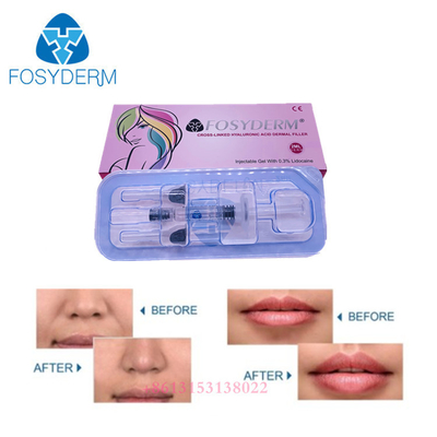 De gezichtsrimpel Ha gelatineert Huidvuller Injecteerbare Hyaluronic Zure Vuller voor Lippen