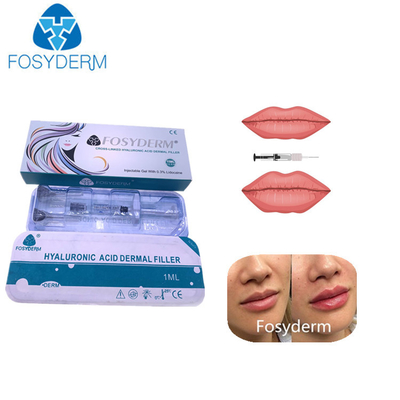 1ml dwars Verbonden Hyaluronic Zure Huidvuller voor de Kin van de Lippenneus