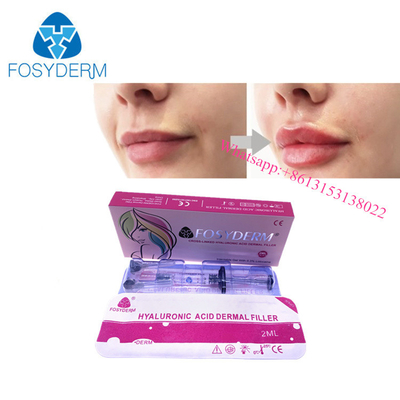 OEM Injectie van het de Vullergel van de Lippenuitbreiding Hyaluronic Zure Huid