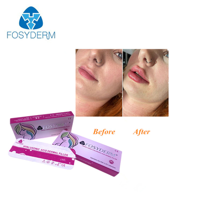 Hyaluronic Zure Huid Injecteerbare Vuller voor Neusgezicht